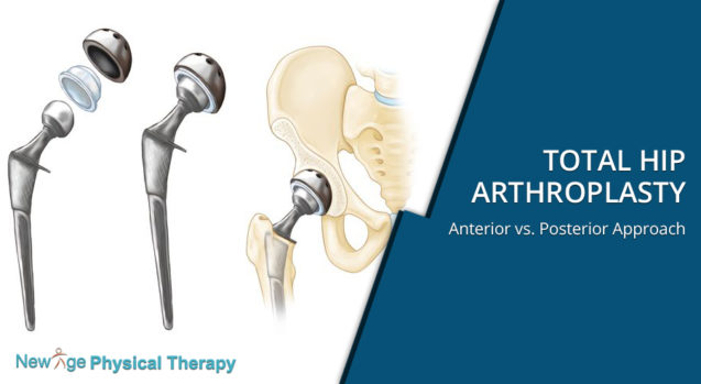 Total Hip Arthroplasty – Anterior vs. Posterior Approach